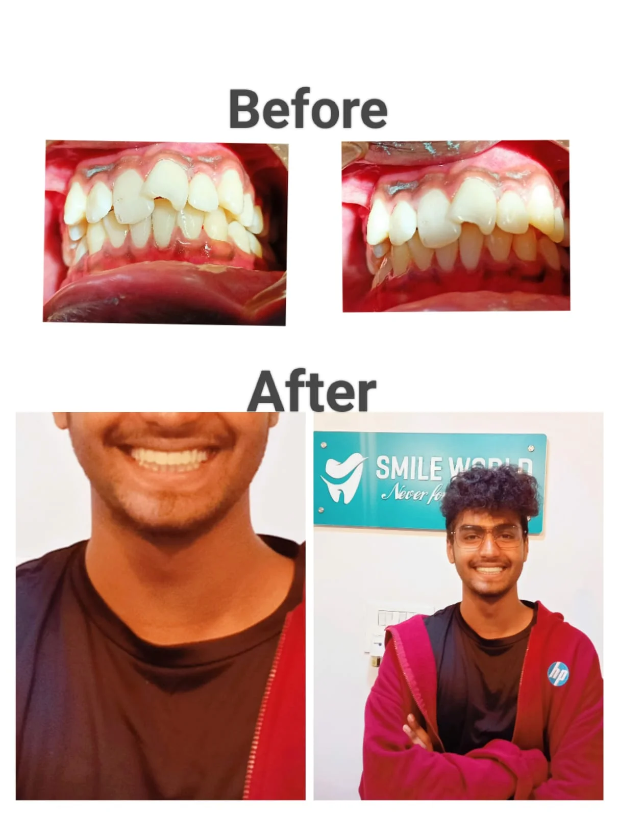 Anterior Smile Correction #4